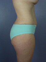 Liposuction Before and after photo