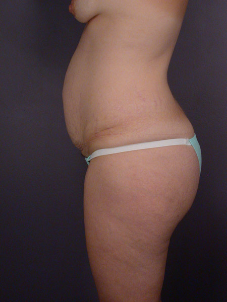 Liposuction before and after photo