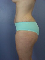 Liposuction Before and after photo