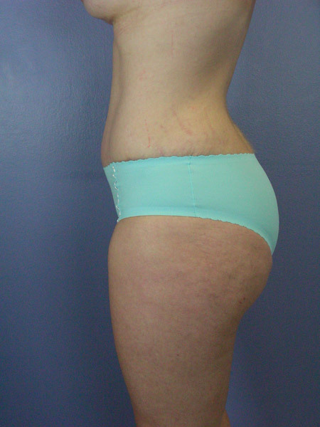 Liposuction before and after photo