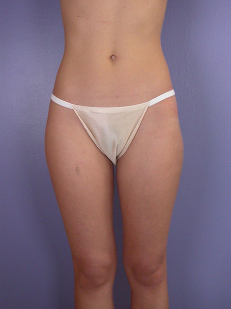 Liposuction before and after photo
