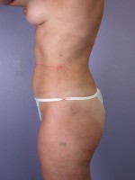 Liposuction Before and after photo