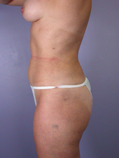 Liposuction before and after photo