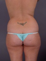 Liposuction Before and after photo