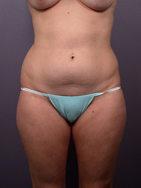 Liposuction before and after photo