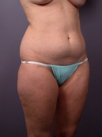 Liposuction Before and after photo