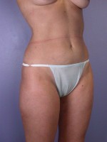 Liposuction Before and after photo