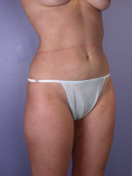 Liposuction before and after photo