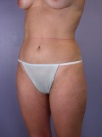Liposuction Before and after photo