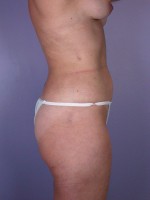 Liposuction Before and after photo