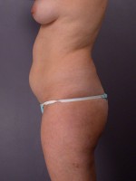 Liposuction Before and after photo
