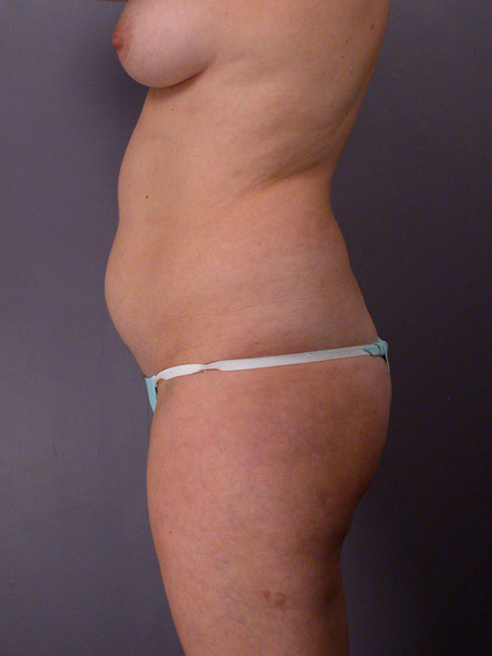 Liposuction before and after photo
