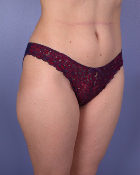 Liposuction before and after photo
