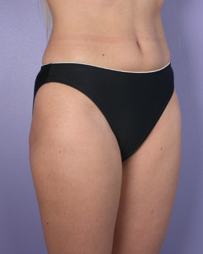 Liposuction before and after photo