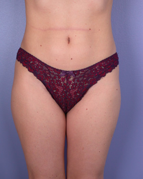 Liposuction before and after photo