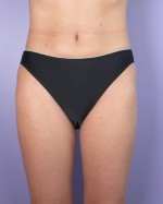 Liposuction Before and after photo