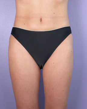 Liposuction before and after photo