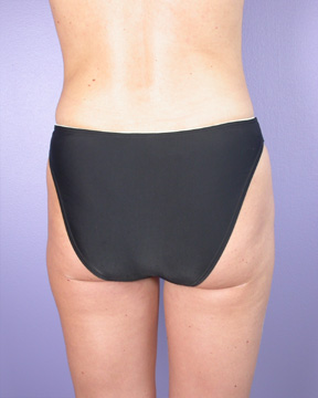 Liposuction before and after photo