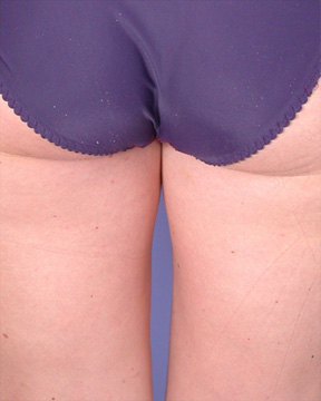Liposuction before and after photo