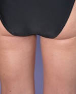 Liposuction Before and after photo