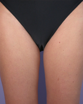 Liposuction before and after photo