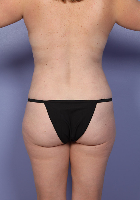 Liposuction before and after photo