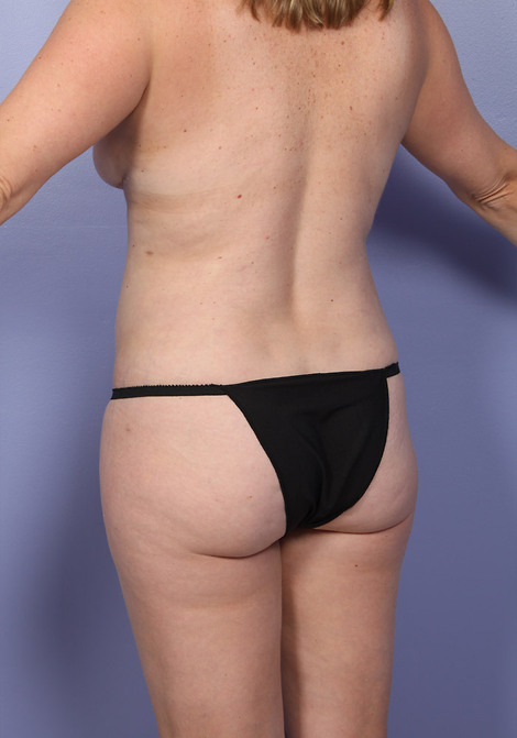 Liposuction before and after photo