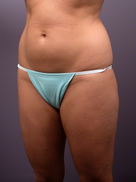 Liposuction before and after photo