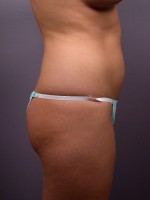 Liposuction Before and after photo