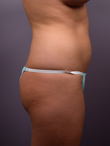 Liposuction before and after photo