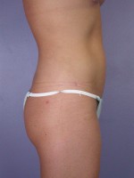 Liposuction Before and after photo
