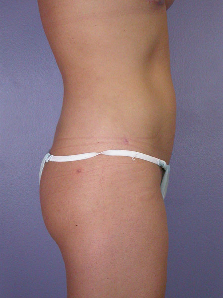 Liposuction before and after photo