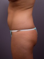 Liposuction Before and after photo