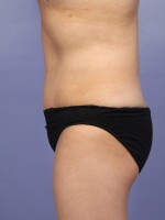 Liposuction Before and after photo