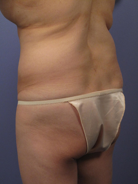 Liposuction before and after photo