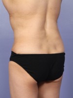 Liposuction Before and after photo