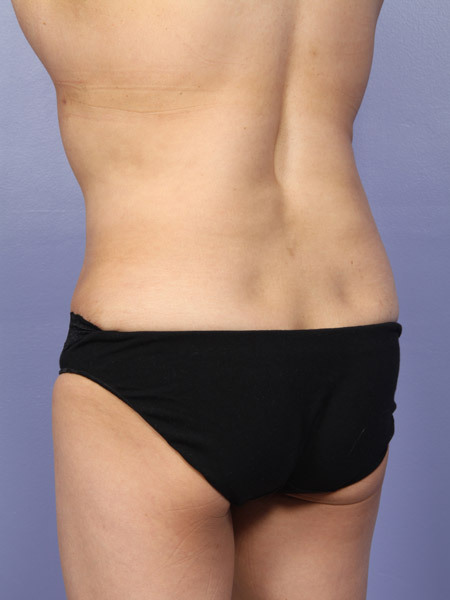 Liposuction before and after photo