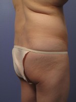 Liposuction Before and after photo