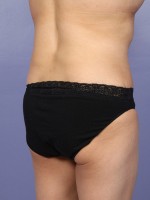 Liposuction Before and after photo