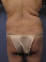 Liposuction Before and after photo