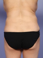 Liposuction Before and after photo