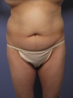 Liposuction Before and after photo