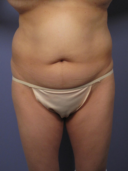 Liposuction before and after photo