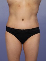 Liposuction Before and after photo