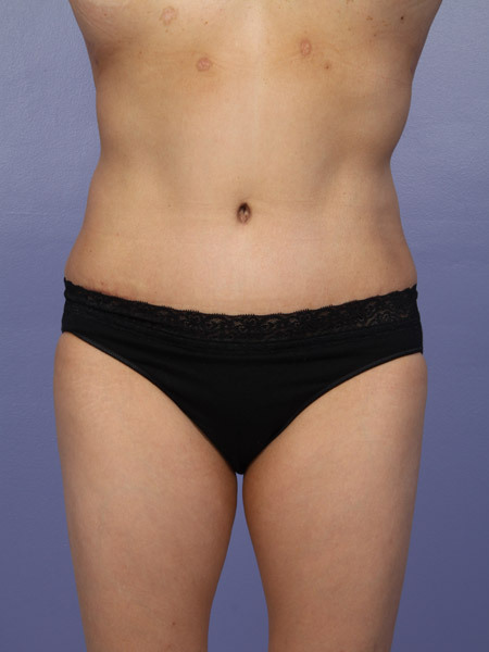 Liposuction before and after photo