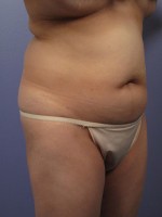 Liposuction Before and after photo