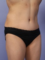 Liposuction Before and after photo