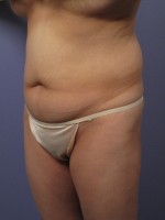 Liposuction Before and after photo