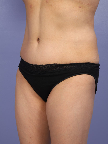 Liposuction before and after photo