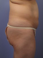 Liposuction Before and after photo